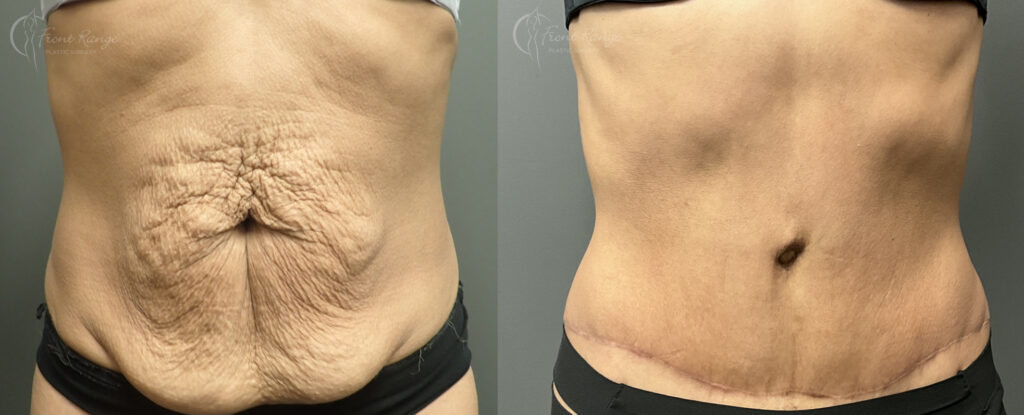 Before and after tummy tuck showing removal of loose belly skin and a low curved scar, revealing a flatter abdomen.