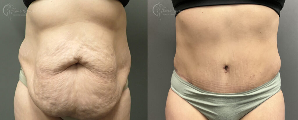 Before and after tummy tuck showing removal of overhanging abdominal skin and smoother, flatter belly.