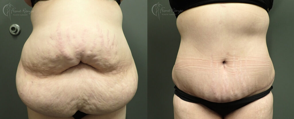 Before and after tummy tuck showing removal of overhanging abdominal skin and a flatter midsection.