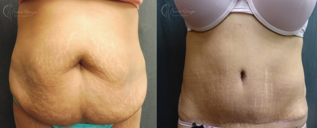 Before and after tummy tuck showing removal of large abdominal apron and a lower scar with flatter waist.