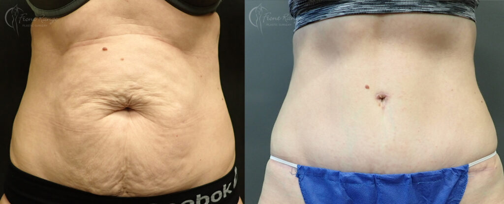 Before and after tummy tuck showing removal of loose skin and a flatter abdomen.