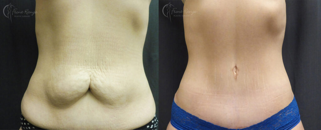 Before and after tummy tuck showing removal of lower abdominal skin and a faint low scar.