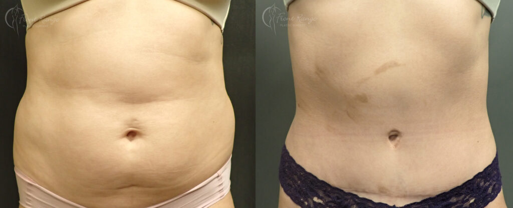 Before and after tummy tuck showing flatter abdomen and a low scar after removing excess belly skin.